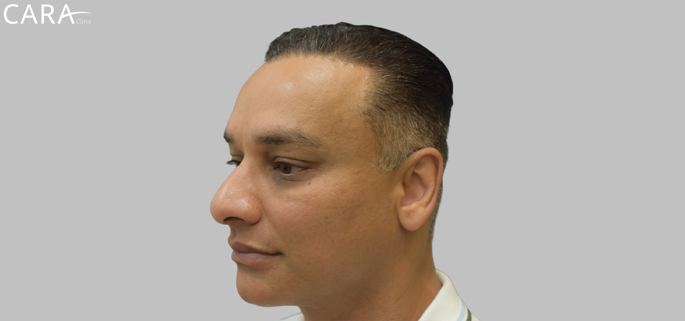 After image of a FUE hair transplant patient showing a natural-looking hairline with thicker, fuller hair.