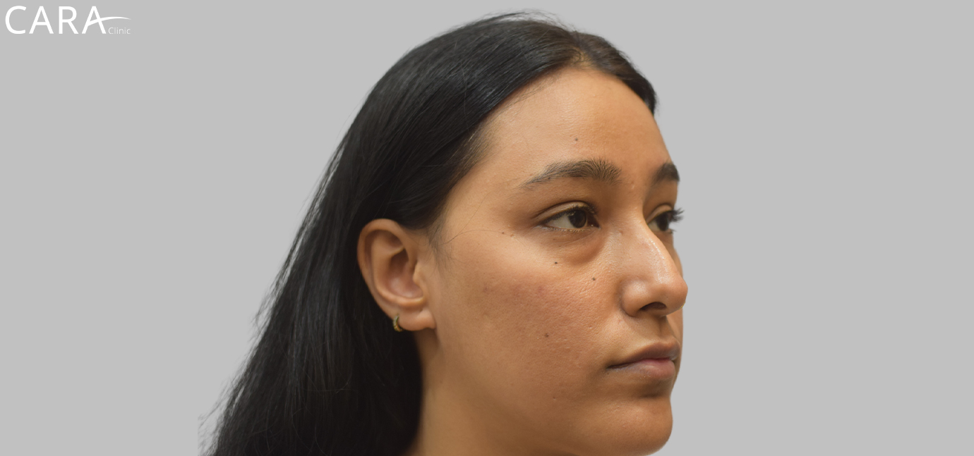 Post-treatment image showing the patient's skin after undergoing acne and scar treatment, with smoother texture, reduced acne scars, and an overall clearer complexion.