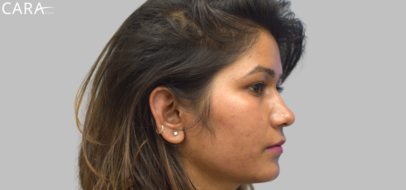 Post-treatment image showing the patient's skin after undergoing acne and scar treatment, with smoother texture, reduced acne scars, and an overall clearer complexion.