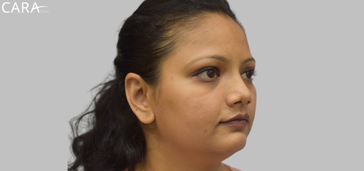 Post-treatment image showing the patient's skin with significant improvement in pigmentation, a more even skin tone, and a brighter, rejuvenated appearance.