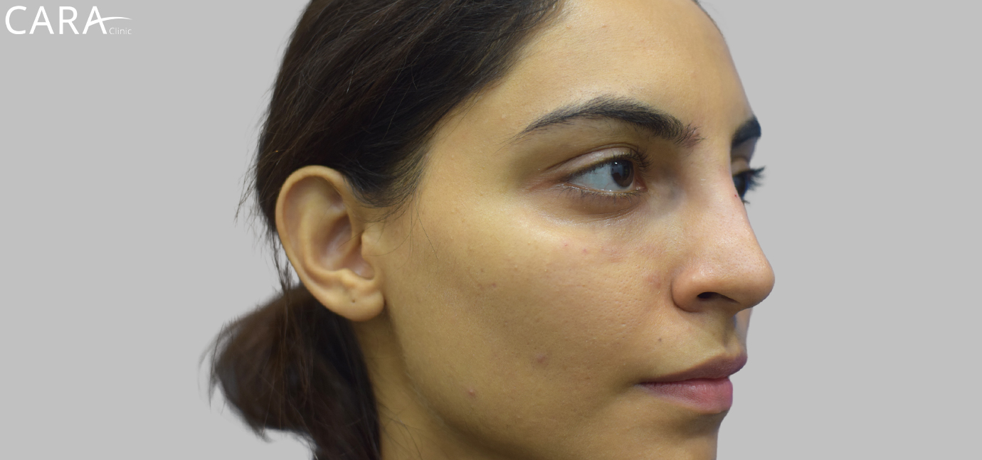 Post-treatment image showing a visibly fuller and refreshed undereye area with smoother contours, resulting in a brighter and more youthful look.