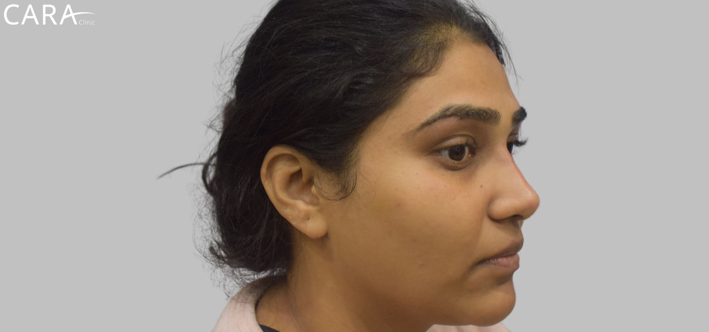 Close-up of a woman's face after non-surgical facelift and masseter reduction, revealing a slimmer, more defined facial structure with enhanced jawline and cheekbone definition.