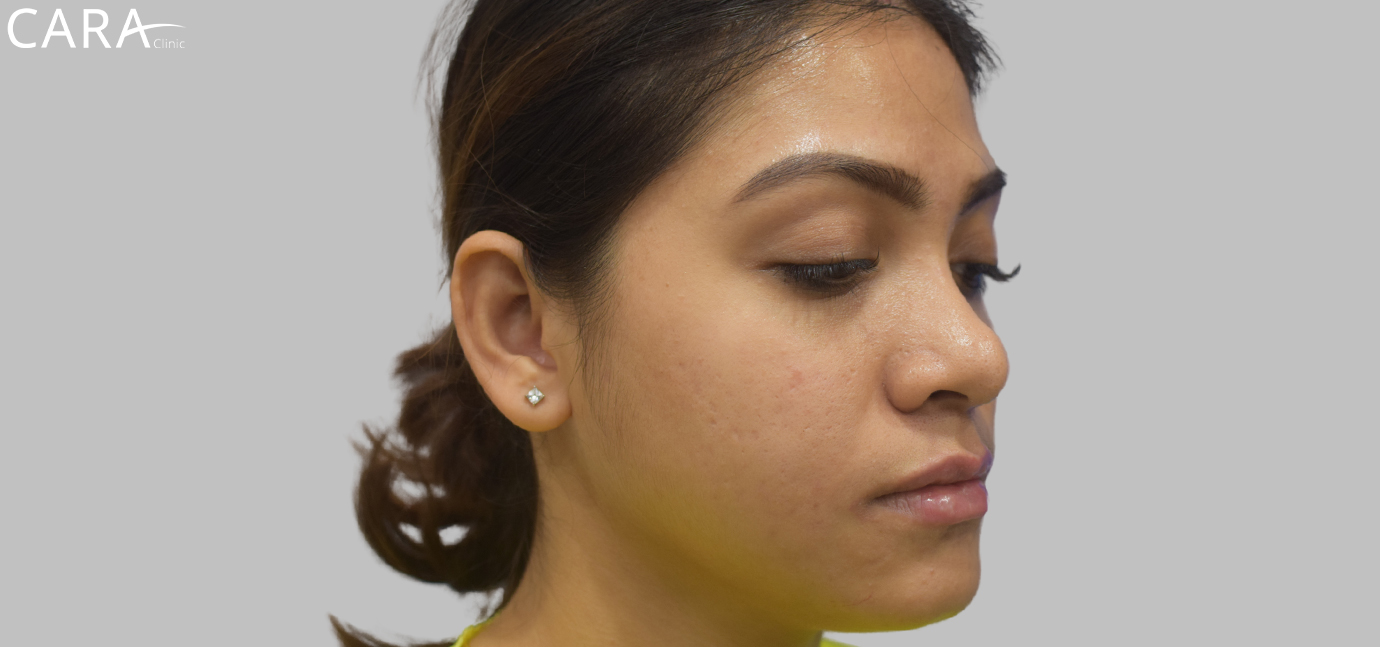 Close-up of lips after dermal filler treatment, showcasing fuller, well-defined, and symmetrical lips with enhanced volume and a natural shape.