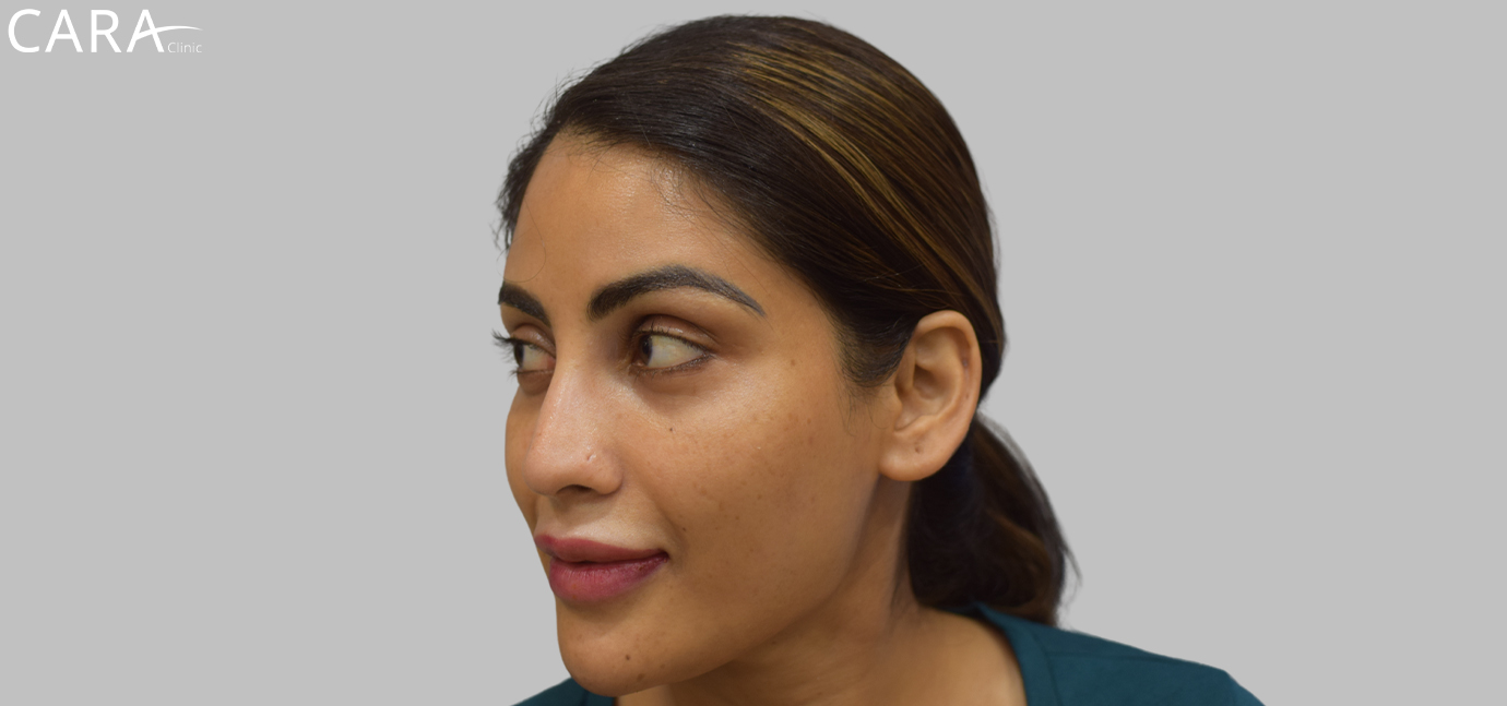 Close-up of the face after dermal filler treatment, showing a well-defined, sculpted jawline and fuller, more symmetrical lips, enhancing the overall facial harmony.