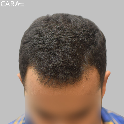 Before Image: Close-up image showing a receding hairline with noticeable thinning along the forehead.