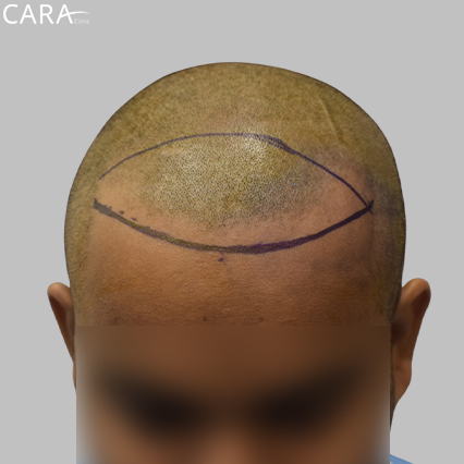 Marking Image: Illustration of the hairline area marked, indicating where transplant grafts are to be placed for optimal coverage and symmetry.