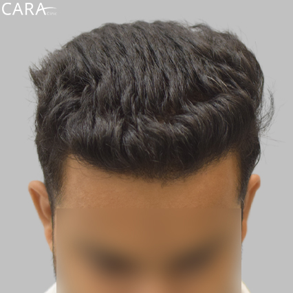 After Image: Image highlighting a fuller, defined hairline with natural hair density post-transplant.