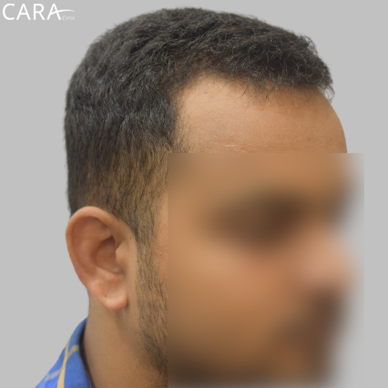 Before Image: Close-up image showing a receding hairline with noticeable thinning along the forehead.