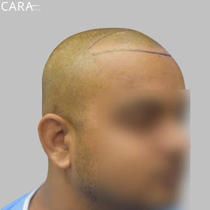 Marking Image: Illustration of the hairline area marked, indicating where transplant grafts are to be placed for optimal coverage and symmetry.