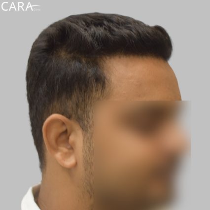 After Image: Image highlighting a fuller, defined hairline with natural hair density post-transplant.