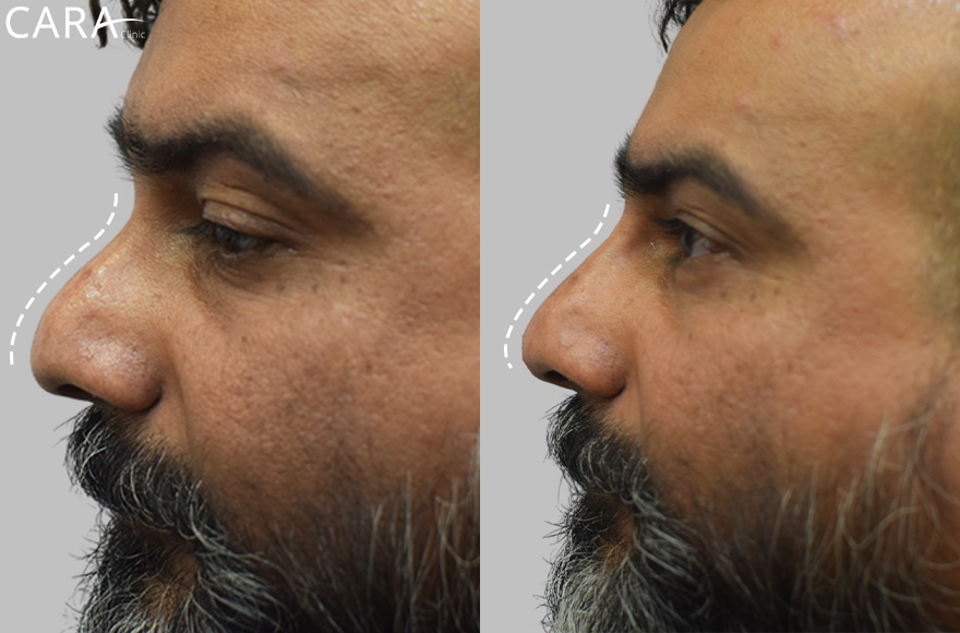 before and after image of non surgical rhinoplasty image