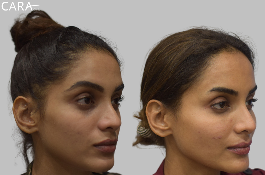 before and after image of female hairloss treatment image