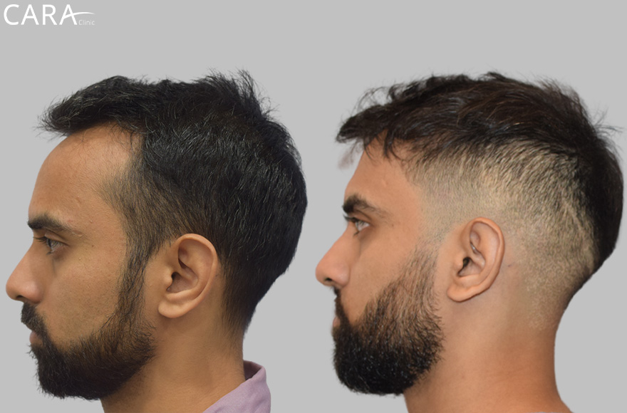 This is the banner image for Hairline Transplant treatment, showing a natural-looking restored hairline