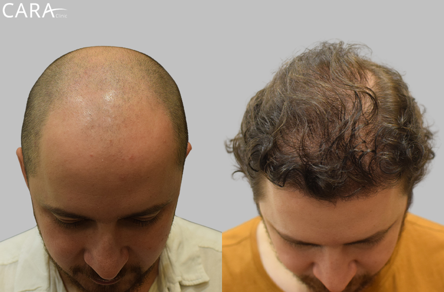 before and after male international hair transplant image