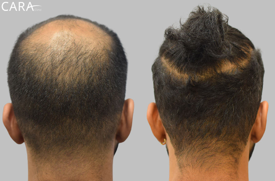 Male hair transplant showing before and after results, with restored hairline and increased hair density.