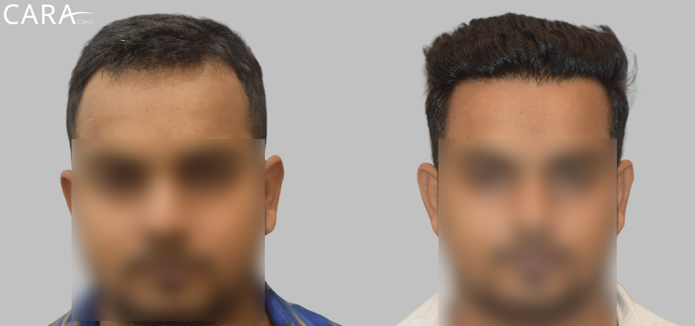 Before and after results of hairline transplant showing natural hair growth restoration using advanced FUE technique at Cara Clinic.