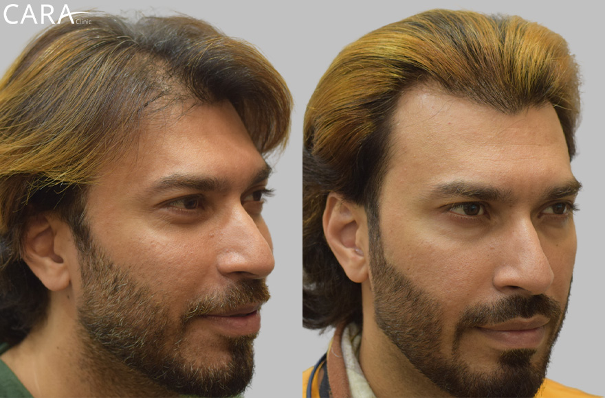 before and after image of male hairloss treatment image