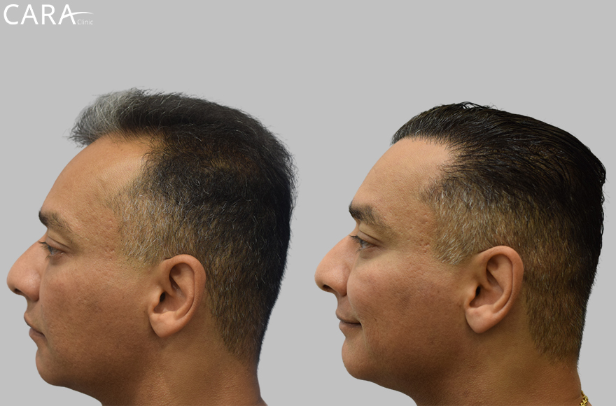 before and after male international hair transplant image