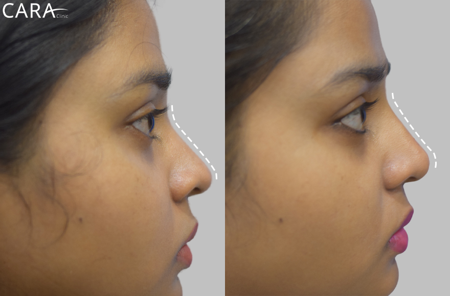 before and after image of non surgical rhinoplasty image