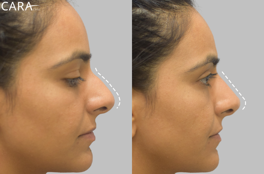 before and after image of non surgical rhinoplasty image