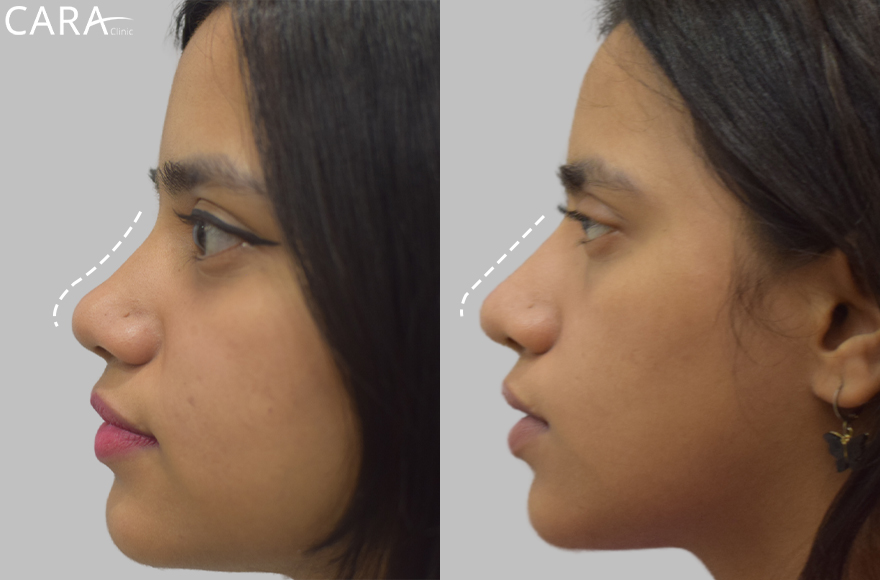 before and after image of non surgical rhinoplasty image