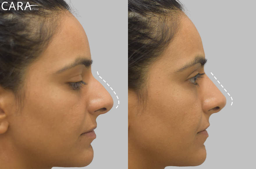 before and after image of non surgical rhinoplasty image