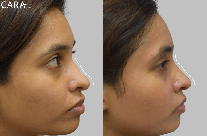 before and after image of non surgical rhinoplasty image