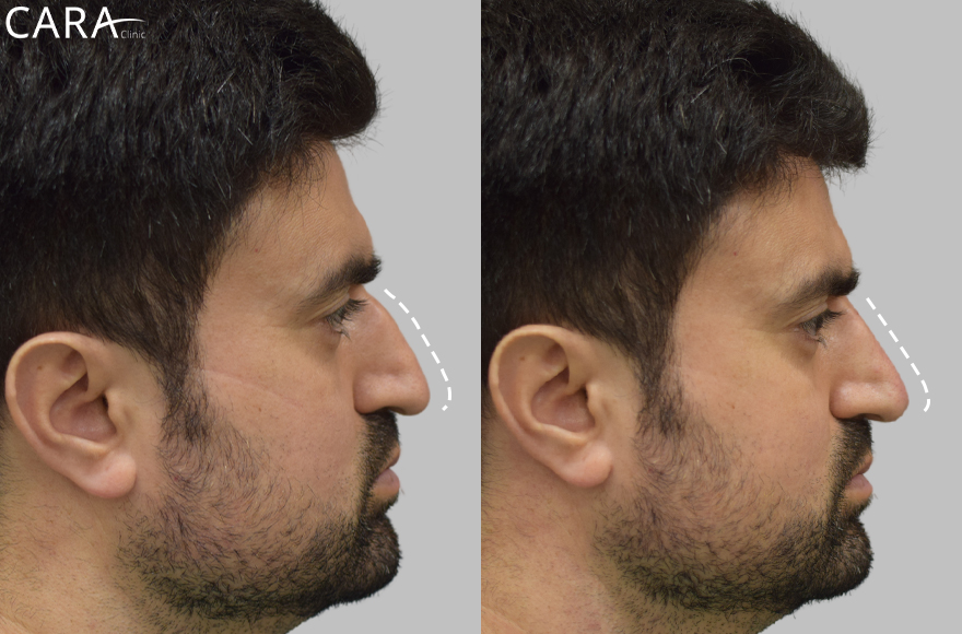 before and after image of non surgical rhinoplasty image