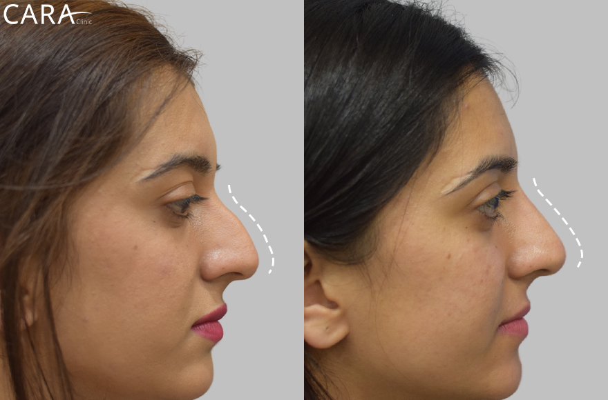 before and after image of non surgical rhinoplasty image