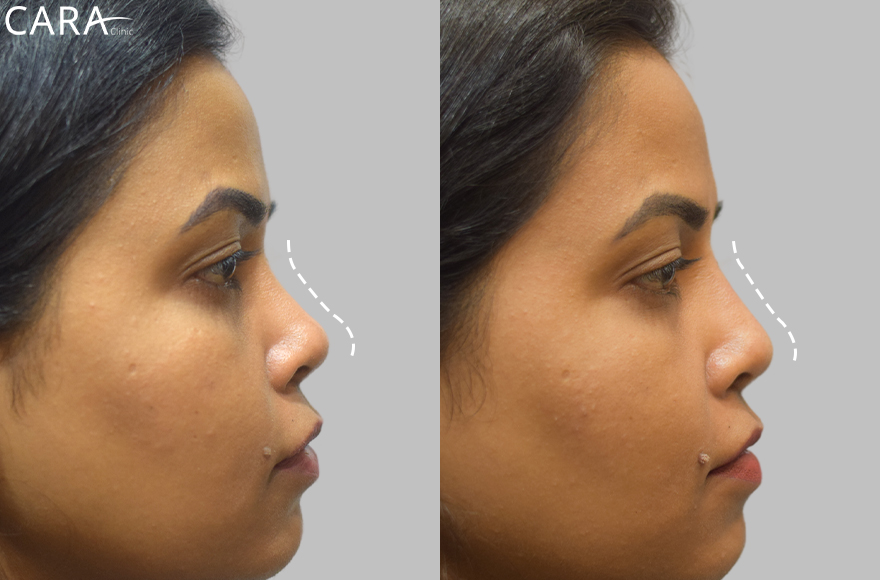 before and after image of non surgical rhinoplasty image