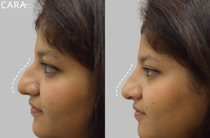 before and after image of non surgical rhinoplasty image