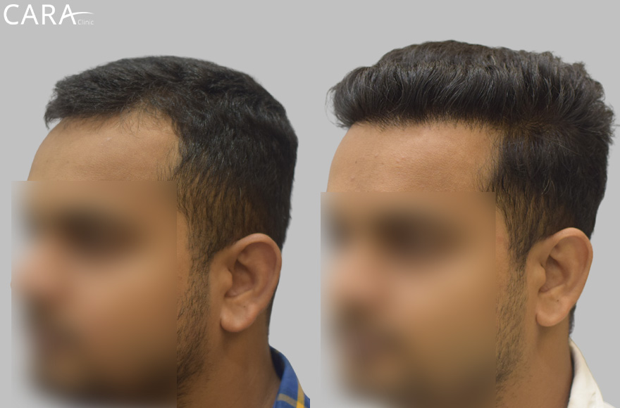 This is the banner image for Hairline Transplant treatment, showing a natural-looking restored hairline