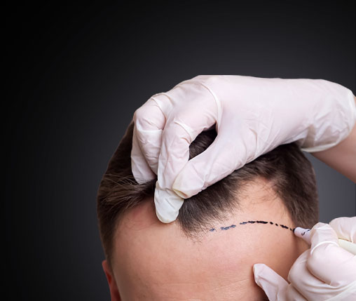 fue hair transplant