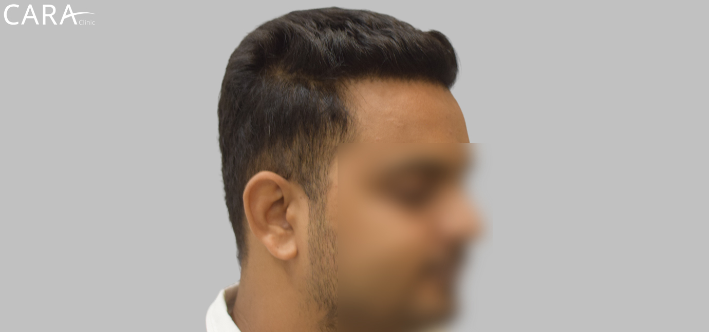 After Hairline Transplant: Patient's restored and natural-looking hairline after hairline transplant procedure at Cara Clinic.