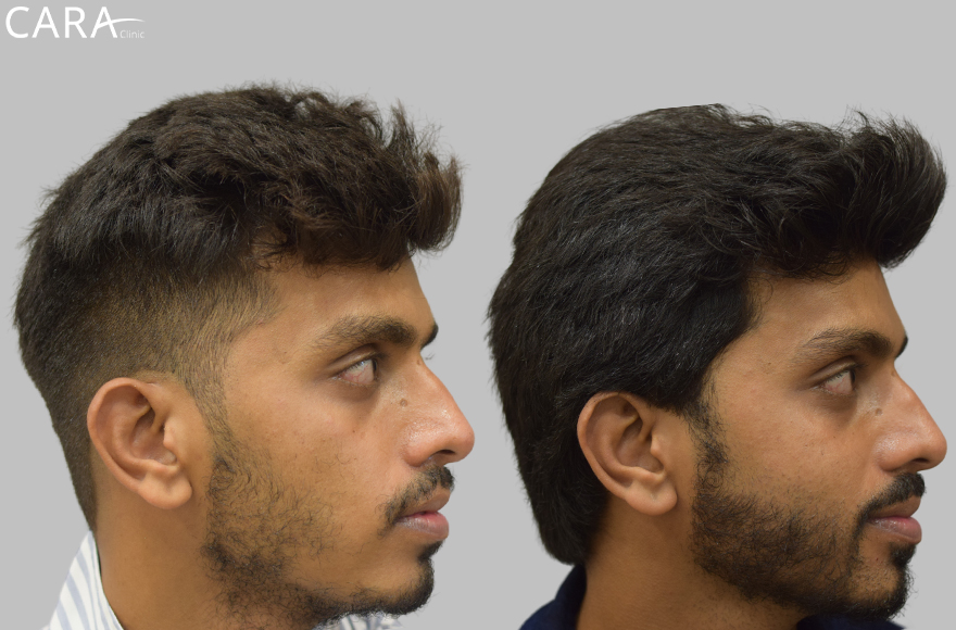 before and after male beard hair transplant image