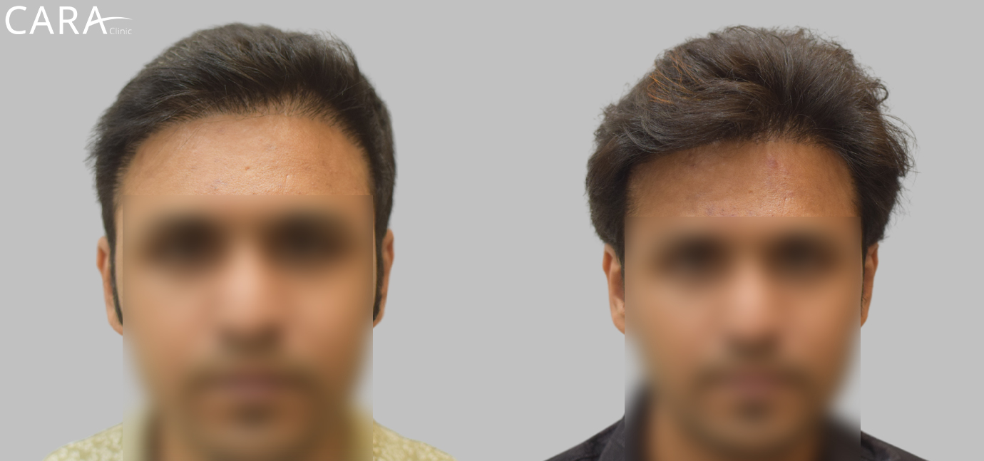 Banner displaying the results of a repair hair transplant at Cara Clinic, featuring a before image with a improper hairline and an after image showcasing a defined, natural-looking hairline restoration.