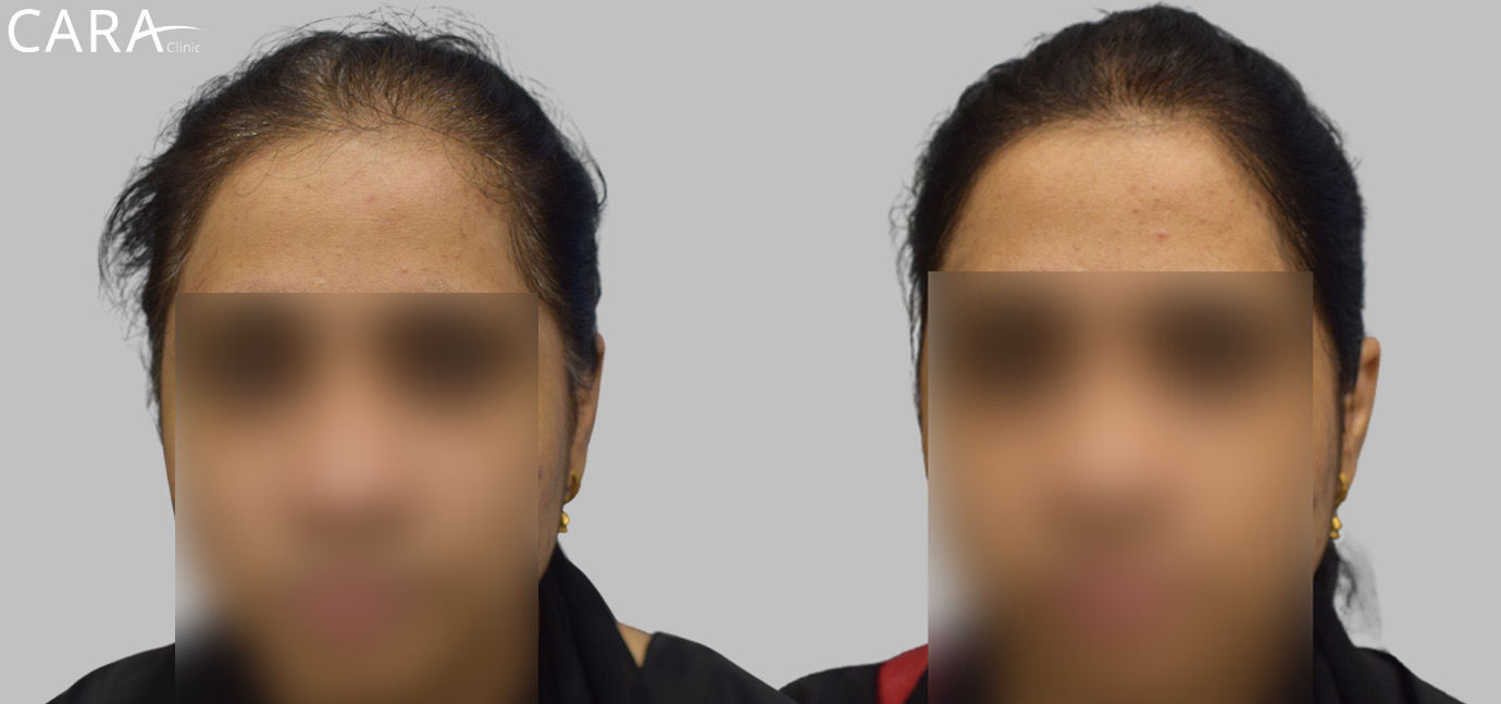 female hair loss treatment before and after banner