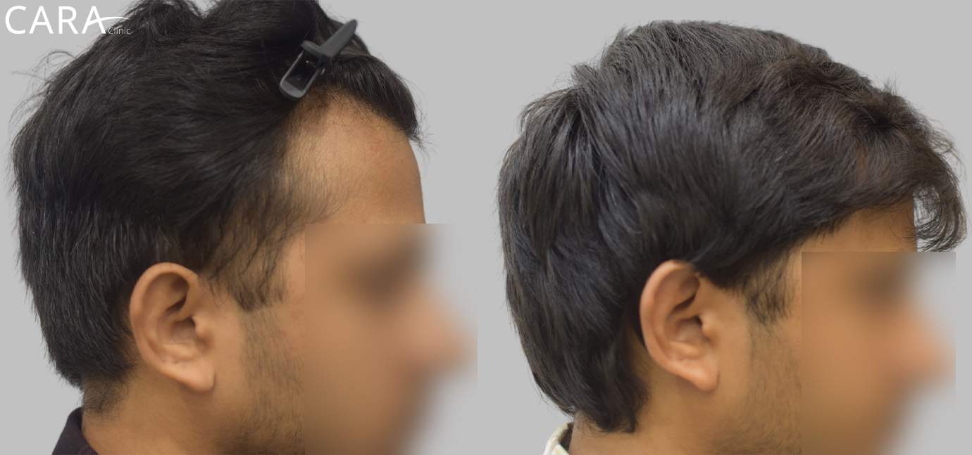 Before and after results of hairline transplant showing natural hair growth restoration using advanced FUE technique at Cara Clinic.