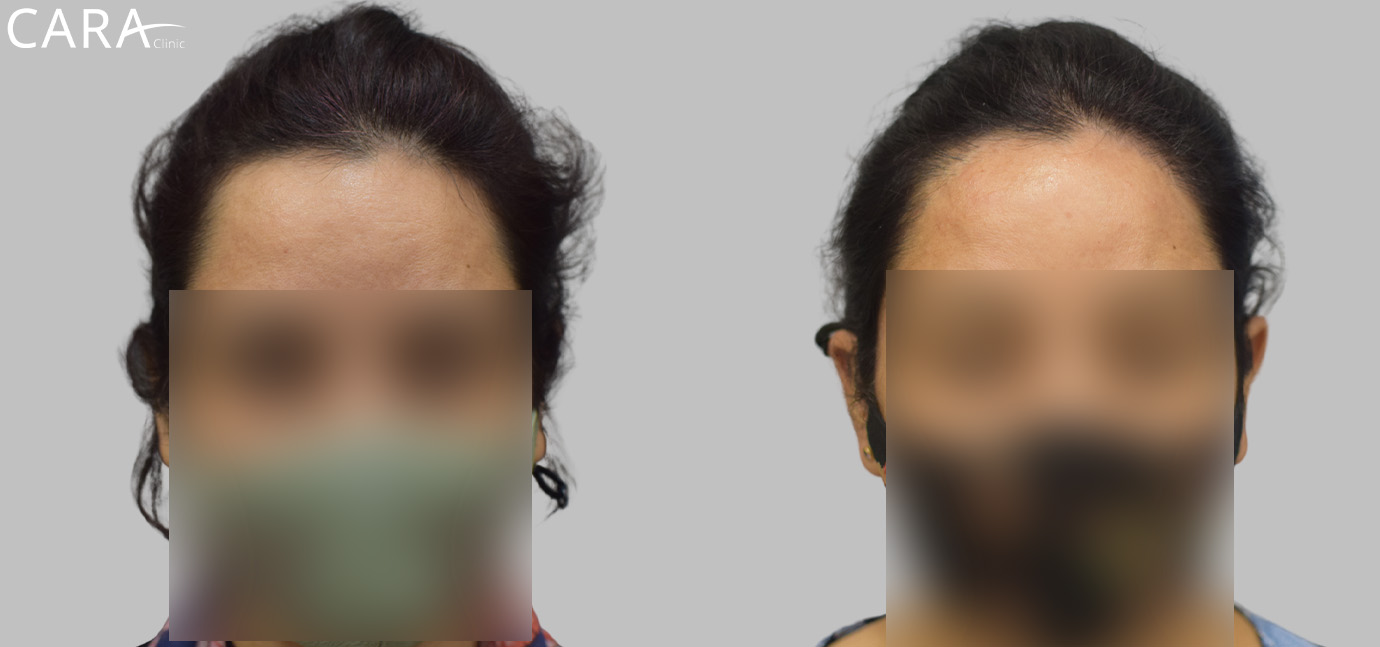 image of a female hair transplant patient showing thinning hair and hair loss in the front and crown areas.