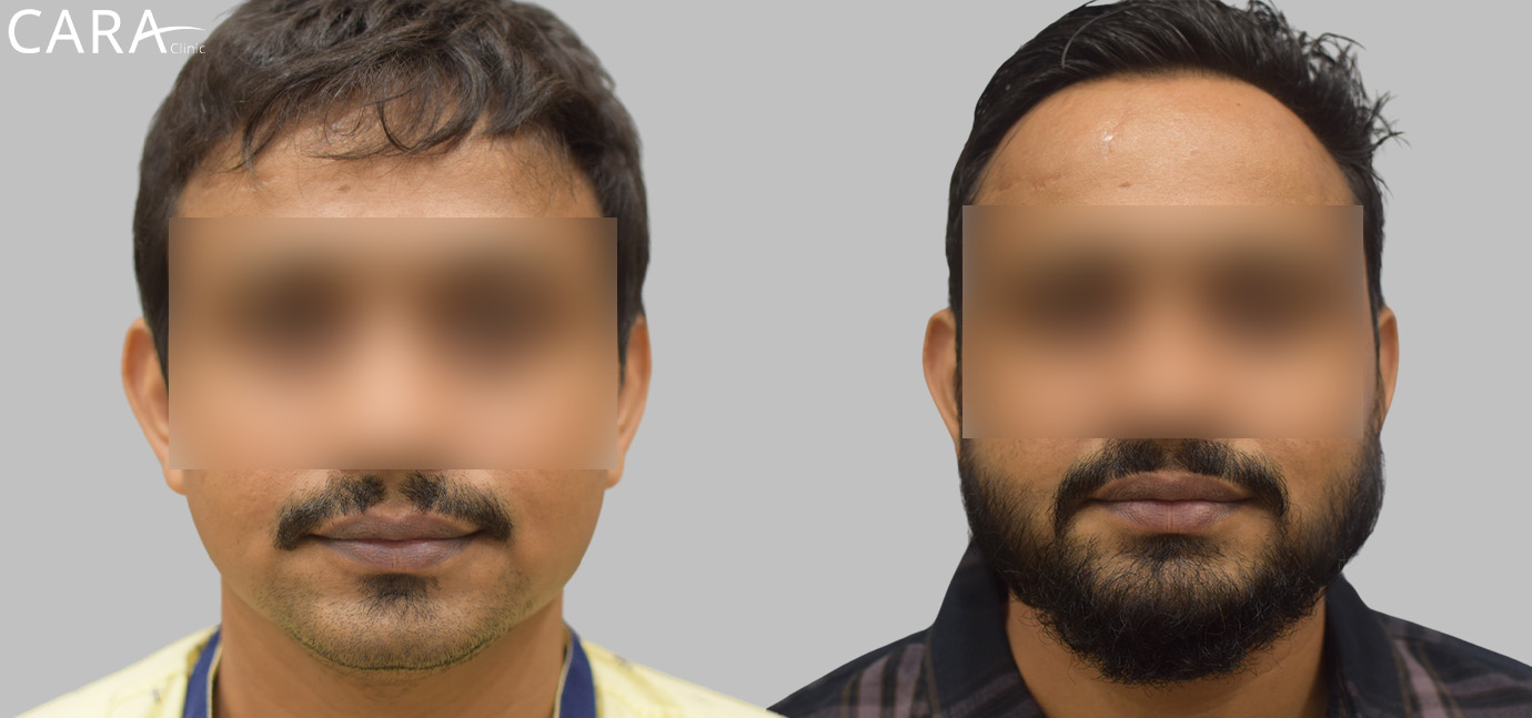 Before and after images of a beard hair transplant showing significant improvement in facial hair density, with a fuller and more even beard appearance.