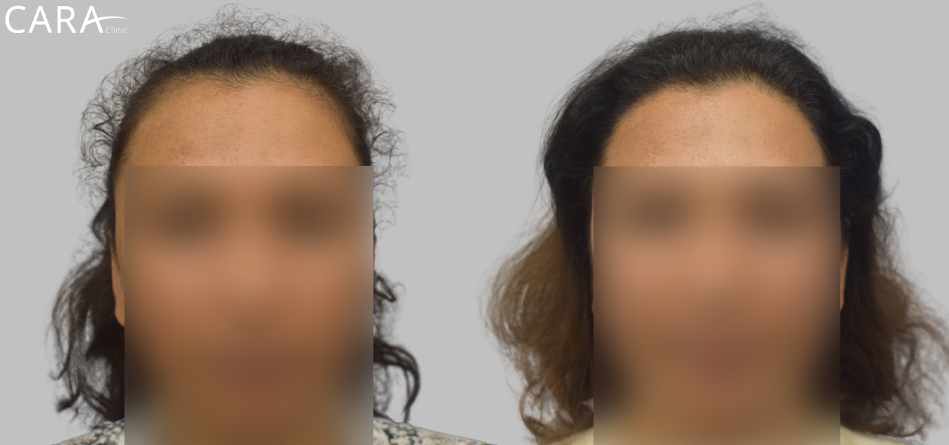 Before and after banner image of a female hair transplant showing significant improvement from thinning hair to a fuller, natural-looking hairline.