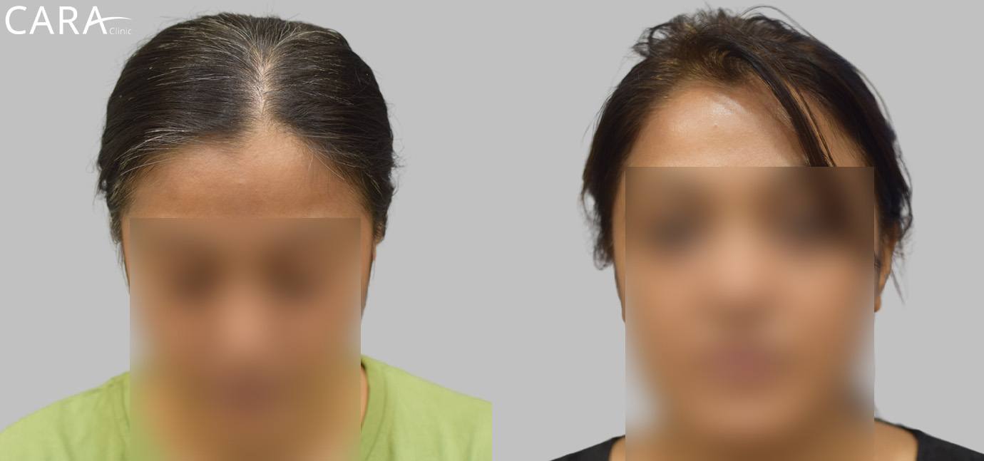 A banner showcasing a comparison of a female patient's scalp before and after hair loss treatment. The after image highlights significant hair regrowth and increased density, demonstrating the success of the treatment.