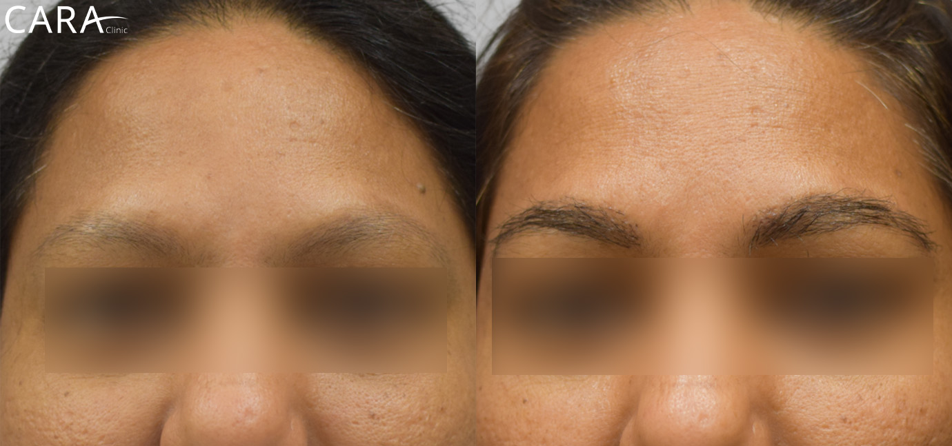 Eyebrow Hair Transplant Before and After: Transformation from sparse, thin eyebrows to fuller, naturally shaped brows with enhanced volume and definition.