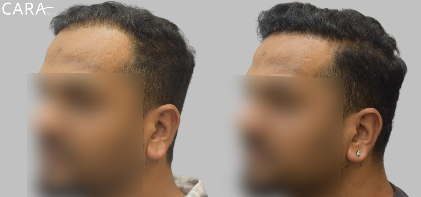 Repairing Unnatural Hairlines: Achieving Natural Results with Sapphire FUE