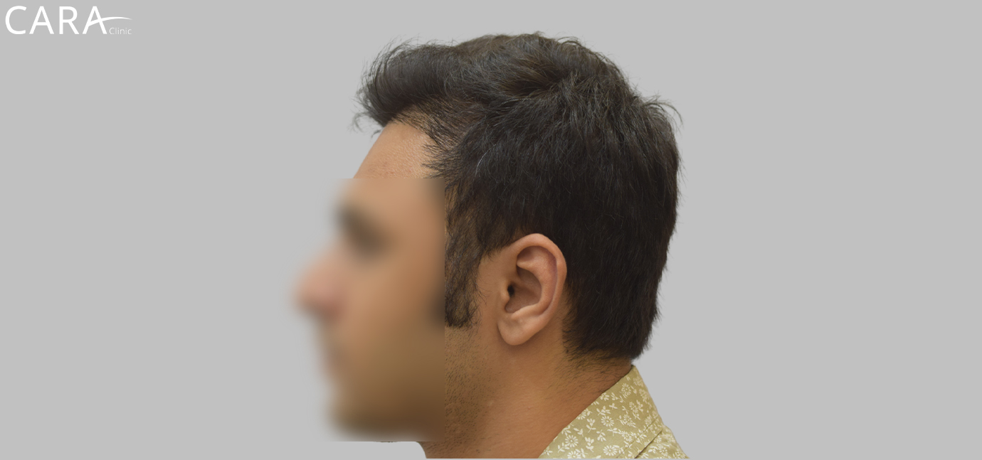 Banner displaying the results of a repair hair transplant at Cara Clinic, featuring a before image with a improper hairline.