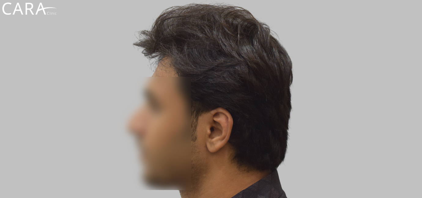 Banner displaying the results of a repair hair transplant after image showcasing a defined, natural-looking hairline restoration.