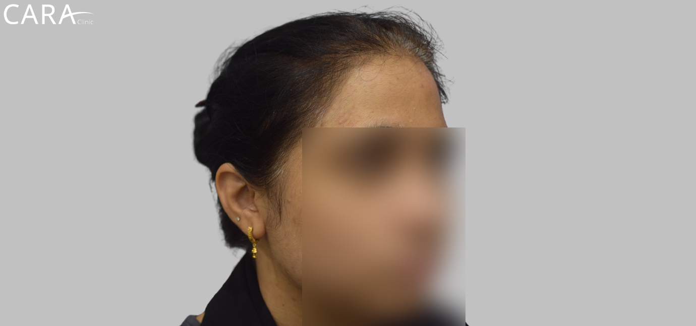 Before female hair loss treatment at Cara Clinic showing visible hair thinning and scalp exposure.