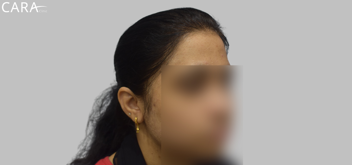 After female hair loss treatment at Cara Clinic highlighting restored hair volume, density, and a fuller appearance.