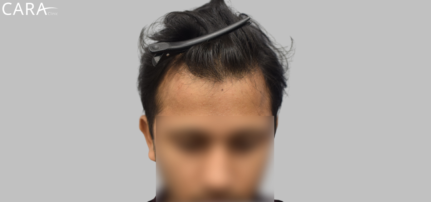 Before Hairline Transplant: "Patient with receding hairline before hairline transplant procedure at Cara Clinic.