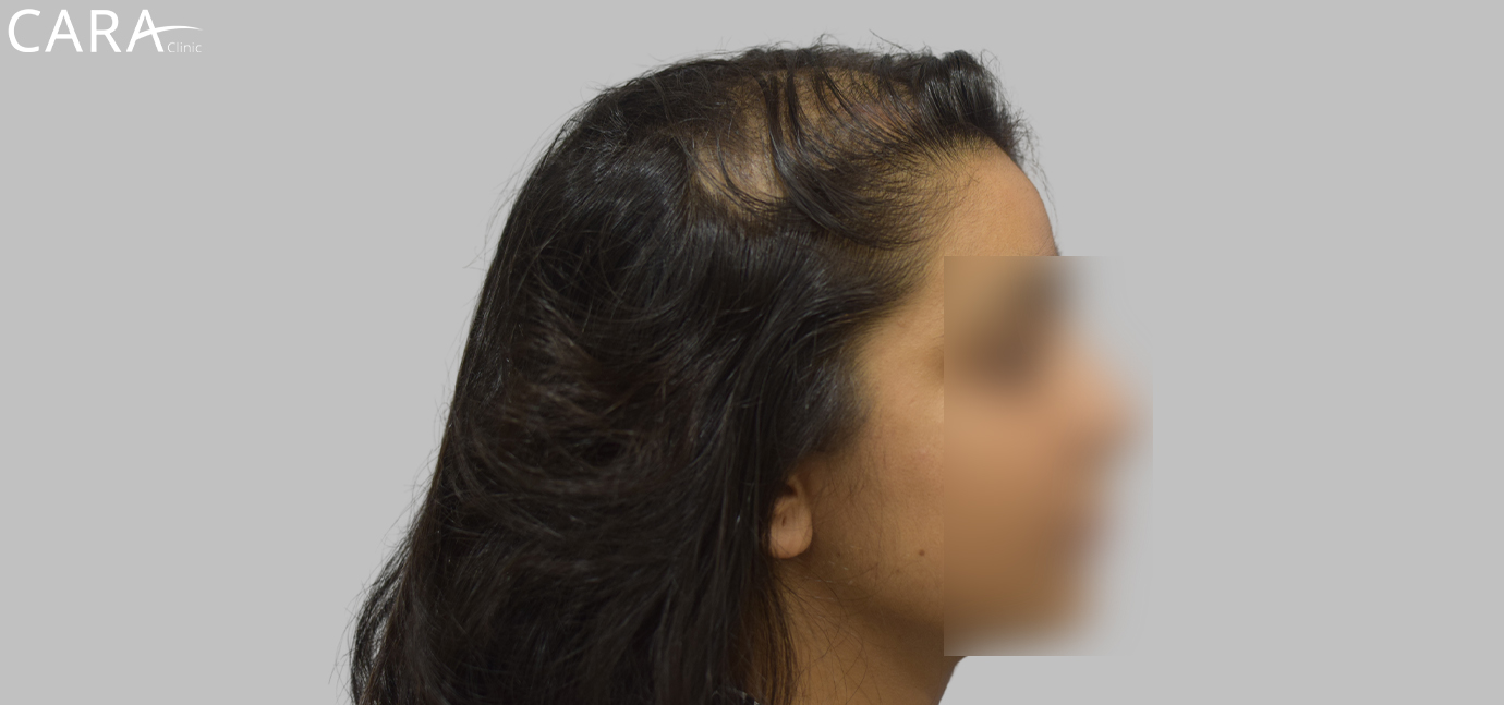 Before female hair loss treatment at Cara Clinic showing visible hair thinning and scalp exposure.